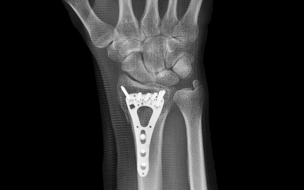 Implant XRay